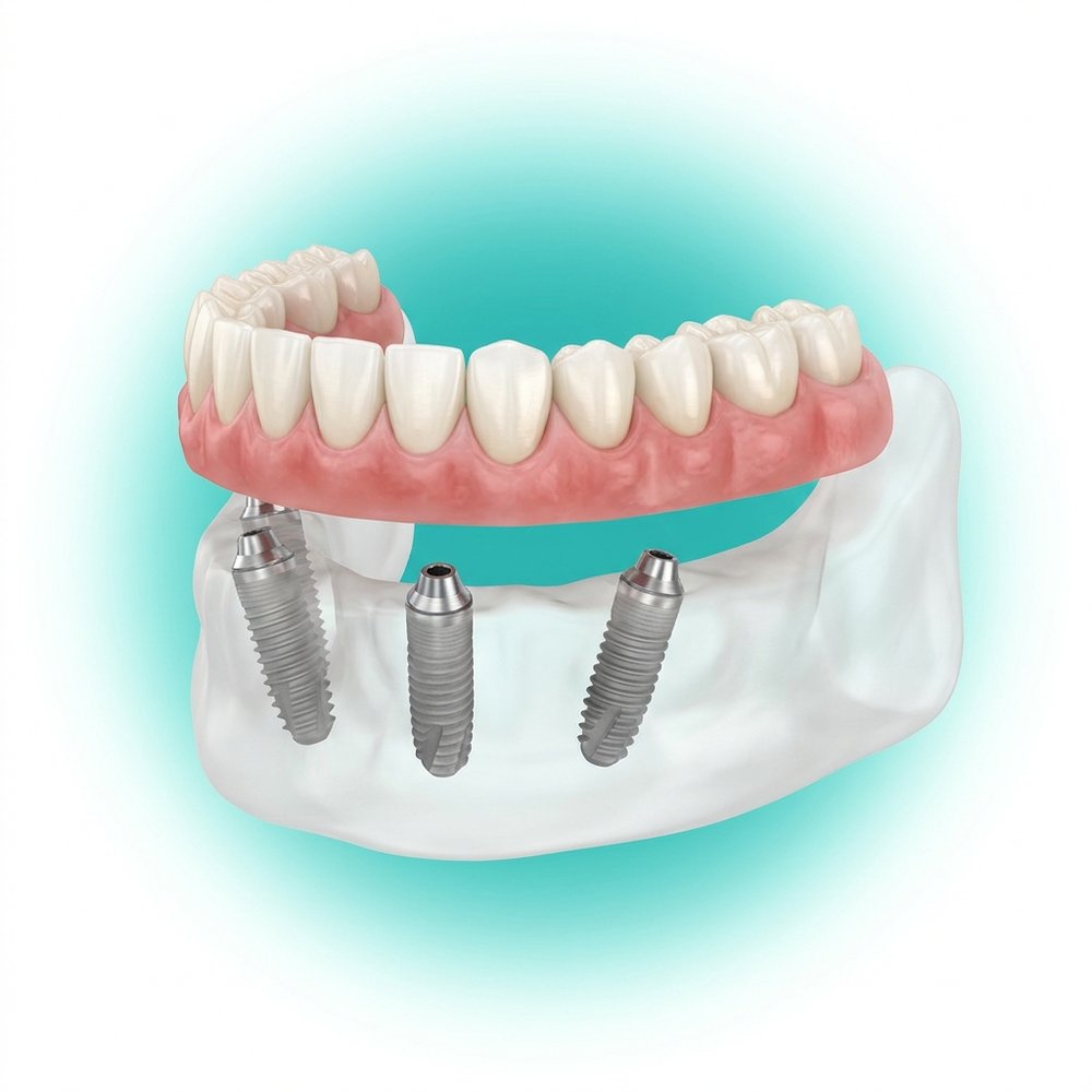 Técnica All-on-4 com quatro implantes sustentando prótese fixa